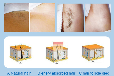 Full Body Facial Hair Removal Laser Machine Permanent Hair