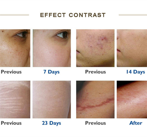 Scars 110V To 250V Fractional Radio Frequency Machine